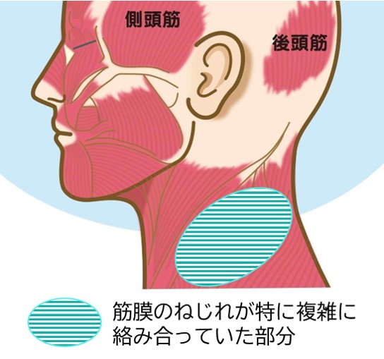 特に筋膜のねじれが複雑に交差・絡み合っている首の左後方部分
