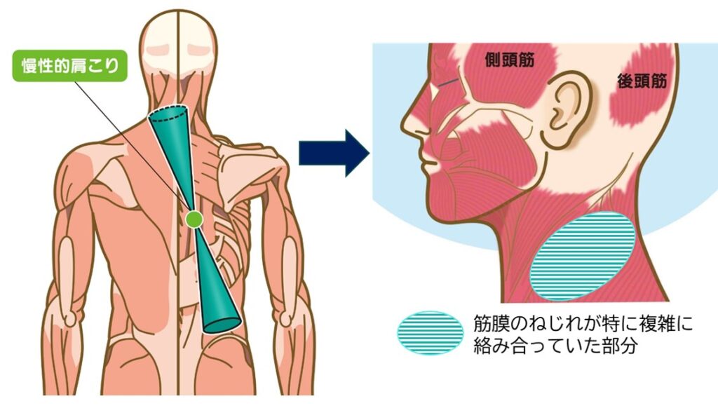 筋膜のねじれが複雑に交差・絡み合っている首の左後方部分