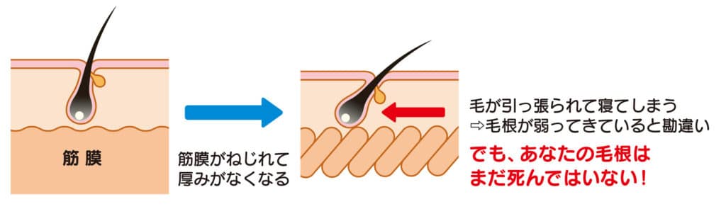 帽状腱膜のねじれによる毛根の移動