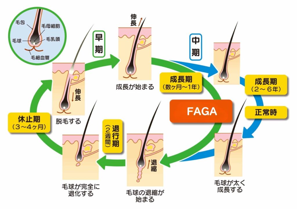 FAGAによる毛髪の成長期（毛周期）の乱れ