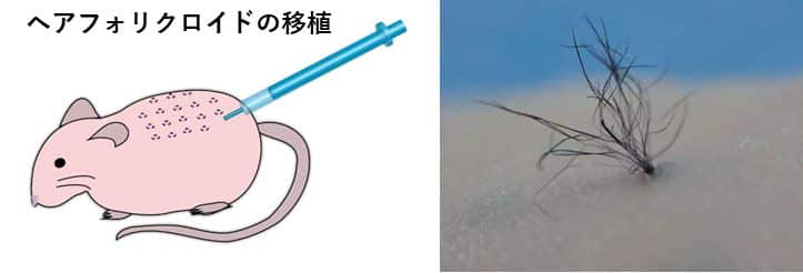 ヘアファリクロイドの移植で再生した毛髪