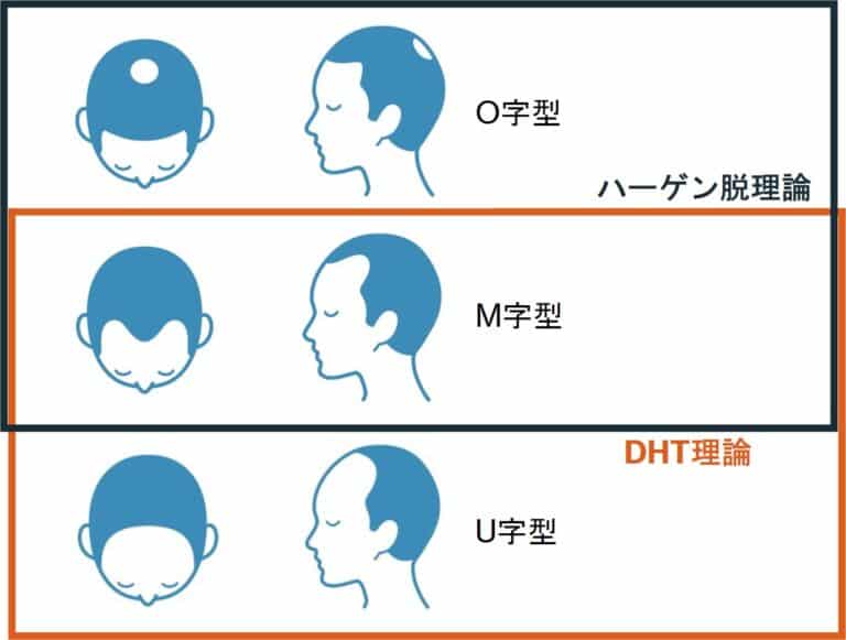 AGAのタイプ別分類と発症パターン｜AGAを巻き戻せ！